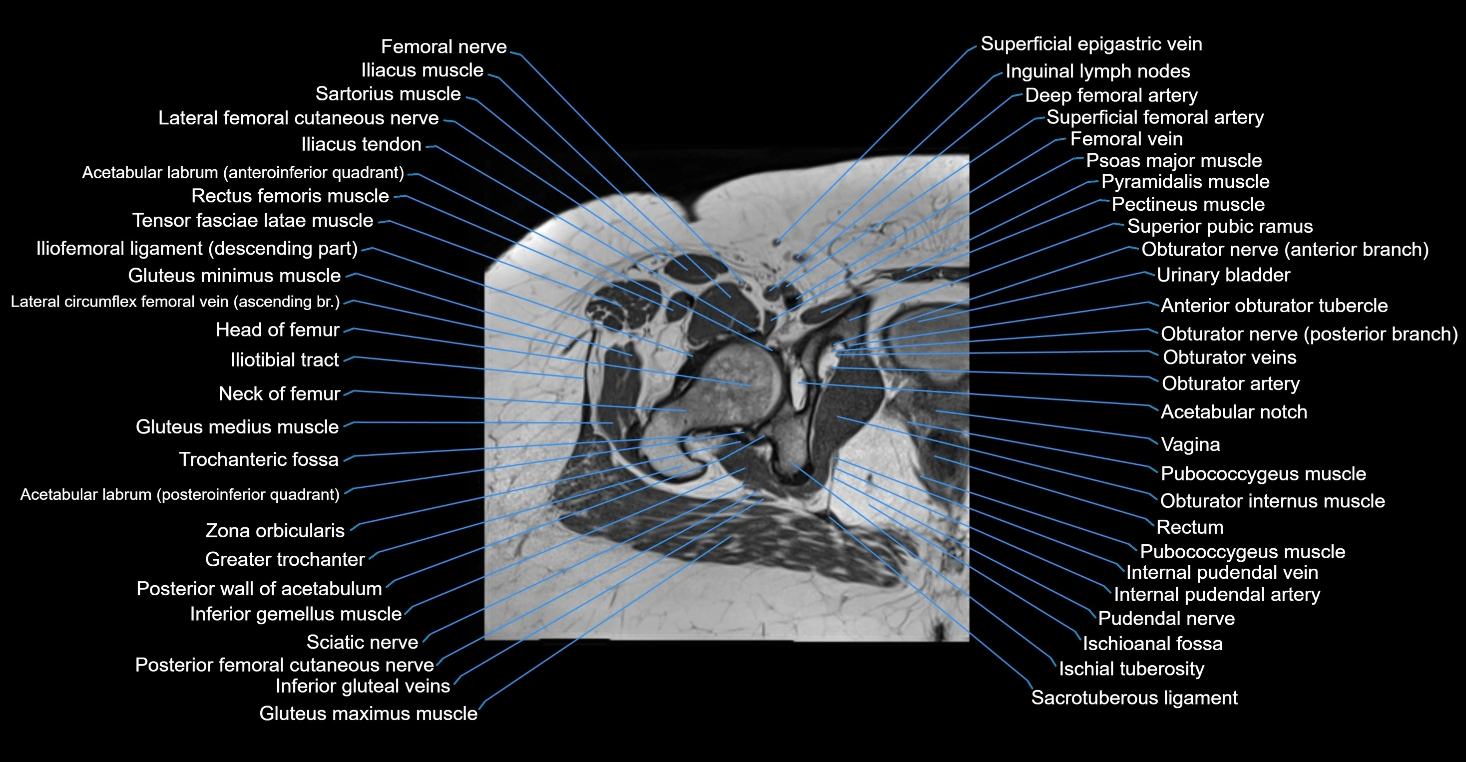 MRI hip axial cross sectional anatomy 3T 3D  radiology  anatomy image-img-00001-00044.webp